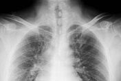 肺癌篩檢的重大突破！麻省理工研發ＡＩ：可預測1～6年內會不會得肺癌