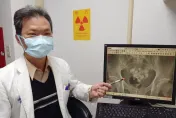 膀胱裡藏24顆鵝卵石！翁「水喝不夠」排尿困難才就醫