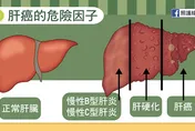 肝膽名醫罹肝癌　腫瘤破掉出血　竟是「天天愛吃這1物」！