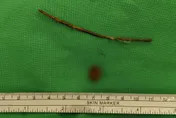 悚！1歲女童腹痛就醫　驚見「9公分樹枝」穿腸