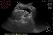 慎入！男做電腦斷層看不到腫瘤　名醫檢查驚見「7cm大香腸」！