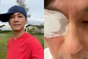 誤把「殺菌頭皮藥水」滴入眼！男星爆痛就醫「角膜慘遭灼傷」　驚悚傷勢照曝
