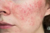 這種「自體免疫疾病」好發於年輕女性！最常見症狀竟是「它」