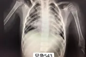 流感季節來臨　醫警告：小朋友注意！「RSV」似乎正在爆發中