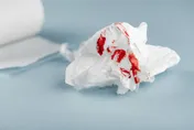 男子摳痔瘡爆血！忍半年「蛋蛋也遭殃」　醫一看傻眼：「那是菜花」