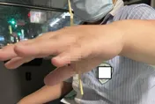 9歲男童拍破垃圾袋下秒慘了…手掌遭「10公分竹籤刺穿」嚇壞送醫