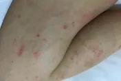 打完疫苗皮膚癢？醫：六症狀可能是嚴重藥物疹