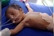 印度女嬰剛出生「肚子好大」　醫驚：體內8個寄生胎