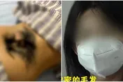少女腰部長出「一叢濃密黑森林」　就醫竟是這裡有問題