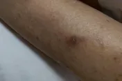 噁！8旬嬤皮膚癢就醫　驚見皮膚「被蟲挖地道」！一人中標全家都有