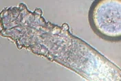 視力模糊又腫癢！她就醫驚見眼瞼「上百隻蟎蟲」亂爬　每根睫毛藏9隻