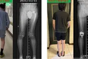 挑戰極限！重度血友病患者多關節一次換　 整合治療照護更全面