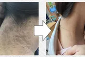 24歲女「脖子發黑」血糖飆高！醫檢查發現竟是「這1原因」