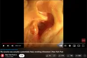 【影】慎入！男子耳內暴痛就醫檢查　醫一看傻眼「耳道內全是蠅蟲！」