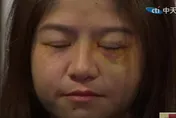 太玄宮女執事稱臉是被眼鏡刮傷　網友：怎麼看都是瘀青