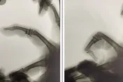 手指骨折不容小覷　醫：嚴重恐無法工作！