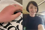 寶媽飛3趟日本　回台蚊蟲一叮「手腫成紅龜粿」醫曝原因