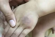 莫名瘀青竟「肝硬化」！醫示警「3情況」不單純速就醫！