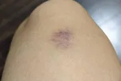 4歲童滿腿瘀青「疑遭暴力對待」　就醫檢查才知罹患嚴重疾病　肝腎恐出問題