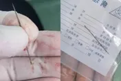 27歲男胸痛1個月就醫驚見2.4公分異物插肺　取出「生鏽繡花針」醫傻眼！