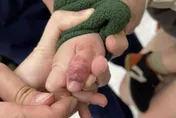 別亂親！幼童拇指長「整串珍珠」醫點名1病毒：會躲起來再復發