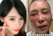 影/不堪家暴訴請離婚…美女人妻遭潑酸毀容　狠夫僅拘10天罰款1770元惹眾怒