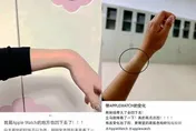 快檢查！戴Apple Watch「手腕凹了」官方回應曝　醫稱出現「這症狀」立刻拿下