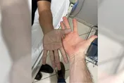 不敢相信！男子雙手突發青緊急就醫　醫詢問後笑翻「你現在就去洗手！」