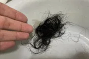 禿頭戴假髮不清潔　皮膚醫：恐加劇脫髮問題