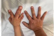 2歲童患「巨指症」手指超巨大！醫曝：若達1條件恐截指