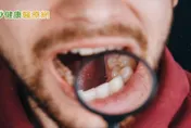 提升口腔癌友出院生活品質！ 「2口腔居家操」助正常飲食、社交