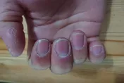 「手指甲長這樣」心臟當心有破洞　恐引發「腦中風與膿瘍」！