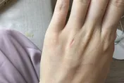 替妹妹除毛…遭削下一塊肉！業者貼OK蹦「再壓人工皮」：只是小破皮　她怒求償被已讀