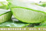 曬傷擦蘆薈真的有效？　醫：2大狀況應立即就醫