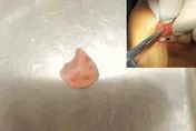 驚！婦人跌倒嘴唇腫脹1個月　竟「卡半顆牙」醫護驚呆