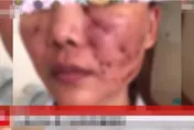 注射1劑「童顏針」滿臉冒膿包！網紅喊煎熬「整整3年不敢外出工作！」