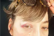 日法混血美女主播摔車慘況曝！忘戴安全帽「以臉著地」縫十多針