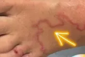 不是香港腳！女子腳背出現紅色紋路搔癢近一周　就醫一查竟是「寄生蟲在蠕動」