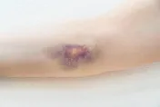 缺少「這個」女童腹部、背部莫名瘀青　醫：免疫性疾病的前兆　應立即就醫治療