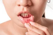 嘴破痛到想哭！營養師曝：吃奇異果、鹽水漱口恐更嚴重