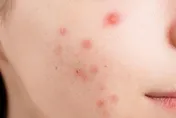 少女吃抗生素治痘痘！竟害無法吞嚥　確診藥物性食道炎