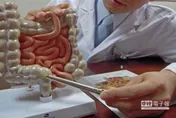 反覆腹瀉加上血便小心是「潰瘍性結腸炎」！　醫1招揪病灶