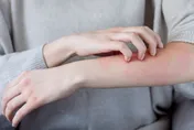 男子服感冒藥全身搔癢、冒皮疹！醫揭「1原因」惹禍：還可能致命