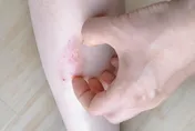 年紀大才出現敏感肌症狀？皮膚科醫揭「4原因」：過度去角質也不行