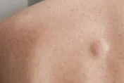 40歲男皮膚多處冒「小腫塊」！醫：基因導致多發性脂肪瘤