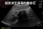 我的天啊！314顆膽結石藏體內　醫籲尿液變色要注意