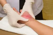 有解嗎？70歲老翁手術後「蟹足腫體質」讓傷口紅腫、癢痛睡不著！