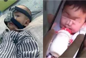 全球僅34例！3歲女童長出罕病「大象鼻」　最嚴重得依賴呼吸器維生