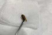 女童耳朵痛！檢查竟是「蟋蟀卡耳道」嚴重恐影響聽力　醫：千萬別自己挖