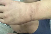 早餐店老闆被騙到柬埔寨加盟淪人囚　驚險逃出！曝火烤傷痕